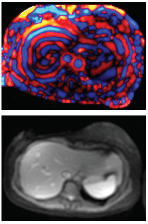 Two representative images from an MR elastography exam. Top: A colorized wave image. The narrow alternating red and blue lines reflect shear waves in a liver with normal stiffness. Bottom: Magnitude image showing the liver.